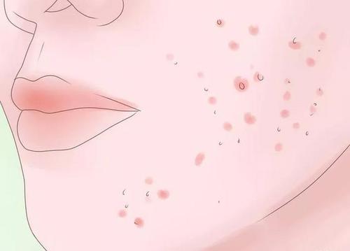 扁平疣什么损害和症状以及如何预防传染呢?