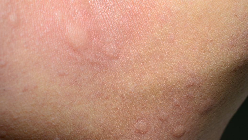 扁平疣的传染性强不强以及生活中如何预防好呢?