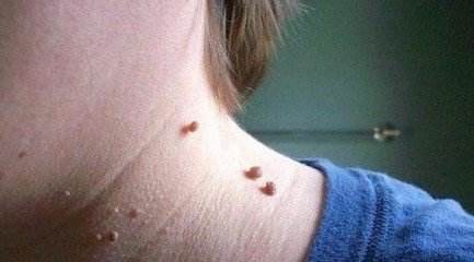 扁平疣都有哪些传染方式以及如何做好防传染护理呢?