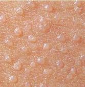 扁平疣都有哪些传染的方式以及如何做好护理呢?