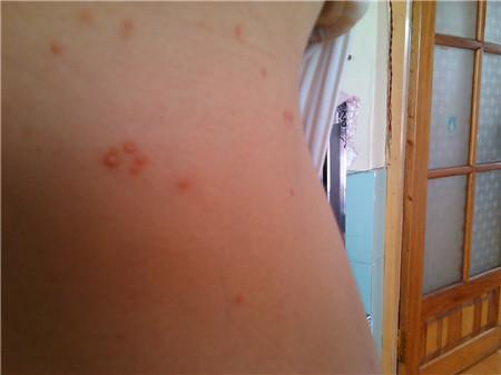 扁平疣引起的疣体损害不治疗会不会自己消退?