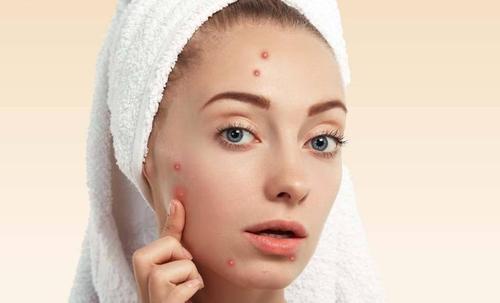 青春痘患者如何治疗和护理能够预防反复复发呢?