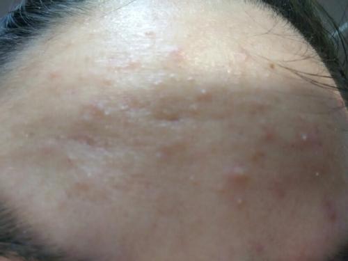 痤疮在临床上的常见病损伤害都有哪些常见表现?