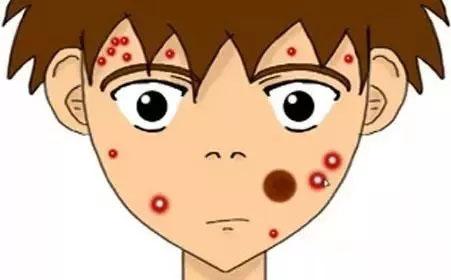 临床上青春痘的发病机制以及治疗费用是多少呢?