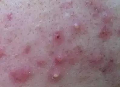 炎热的夏季应当如何预防脸上受到青春痘痤疮的侵袭?