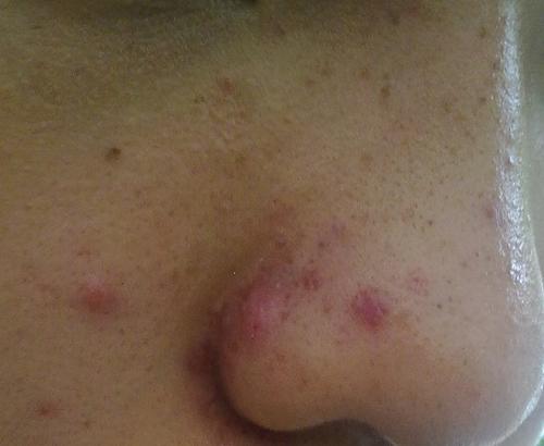 得了痤疮应当怎么做才能更好的减少症状和损害呢?