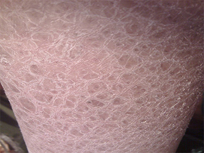 痤疮患者在治疗上大概花多少钱才能去除?