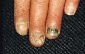 得灰指甲会有的并发症状