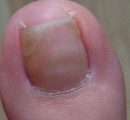 怎么才能预防灰指甲