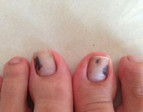 灰指甲是怎么传染的呢？