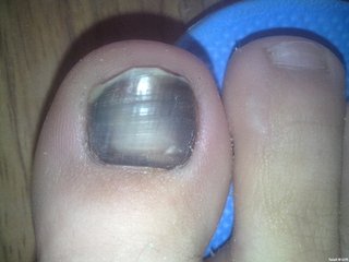 得了灰指甲要注意什么