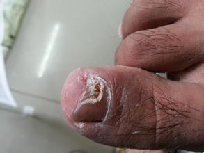 患有灰指甲要不要治？