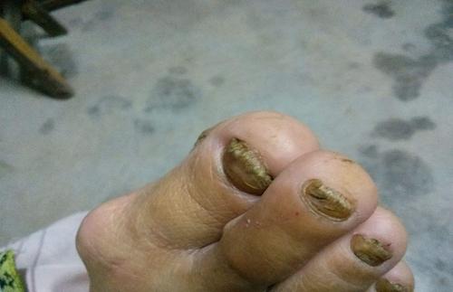 灰指甲在治疗方面应当注意哪些事情能避免反复呢?