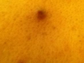 为什么会出现毛囊炎