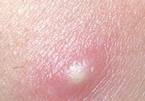 剃毛后毛囊炎图片