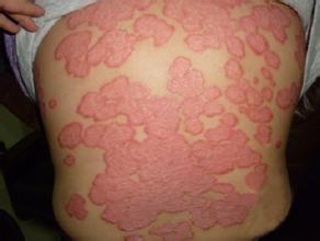 得银屑病造成的影响