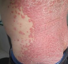 什么是红皮型牛皮癣？