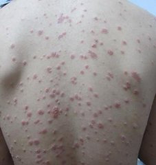 牛皮癣都有哪些类型