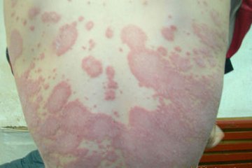 预防牛皮癣复发的方法有哪些