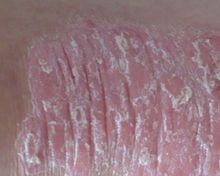 牛皮癣临床治疗前应当如何检查诊断自身的病情呢?