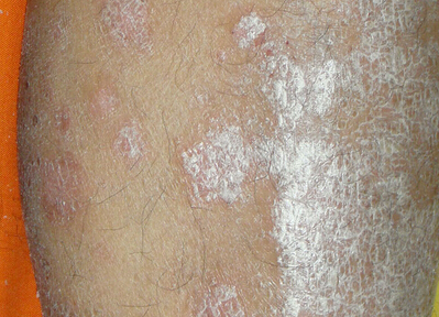 牛皮癣使用中药药浴治疗的原理是什么以及效果怎么样?