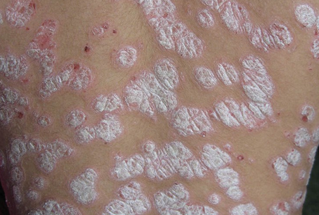 牛皮癣患者应当如何治疗才能更好的达到医治目的?