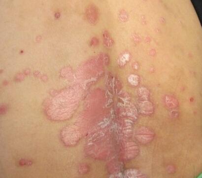 牛皮癣应当如何治疗和护理有助于减轻症状损害呢?