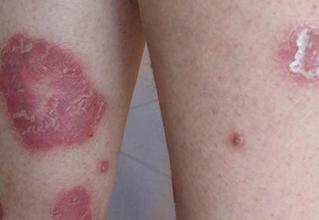 牛皮癣患者临床医治应当慎重使用的药物有哪些?