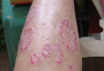 牛皮癣患者治疗上能不能有效的达到标本兼治的目标?