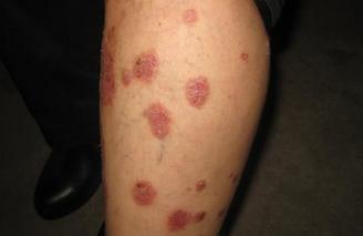 牛皮癣临床上的早期症状表现都是什么样的?