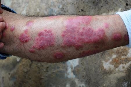 牛皮癣患者怎样配合性的医治能更好的去除损害呢?