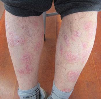 牛皮癣患者如何通过按摩方式缓解症状损害呢?