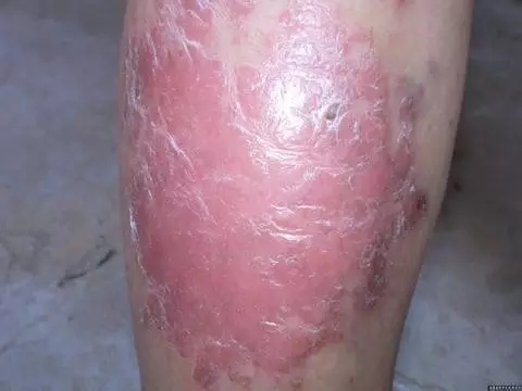 牛皮癣银屑病患者应当如何选择药物方法治愈缓解呢?