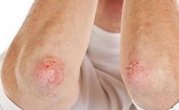 牛皮癣复发的症状损害应当如何医治去除才好?