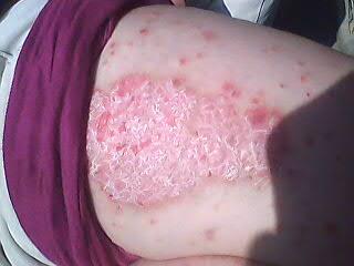 牛皮癣患者怎样选择药物治疗缓解严重的皮肤损害呢?