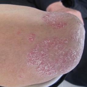 临床上中西医是如何治疗牛皮癣症状损害的呢?