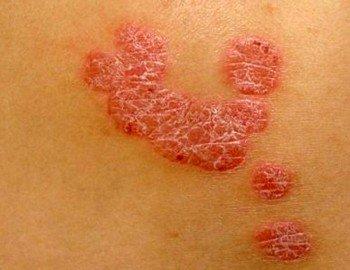 银屑病临床上的发病病理特点是什么呢?