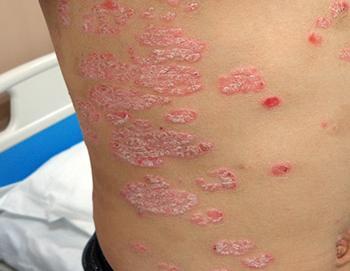 得了顽固性的牛皮癣应当如何治疗才能去除呢?