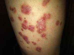 临床上什么是红斑型牛皮癣以及表现是怎样的?