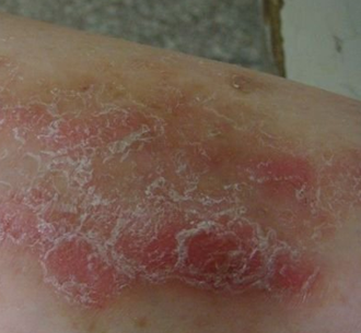 牛皮癣为什么会有季节性以及如何预防护理呢呢?