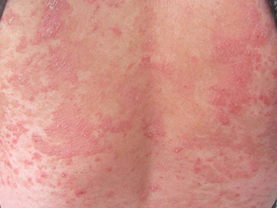 顽固性的牛皮癣应当怎样治疗才能更好的消除鳞屑损害?