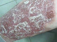 牛皮癣患者在选择治疗用药时应当注意哪些事项?