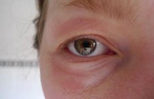 荨麻疹会引发的原因