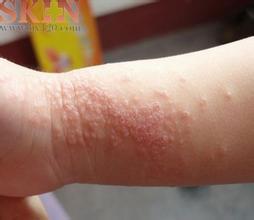 湿疹图片