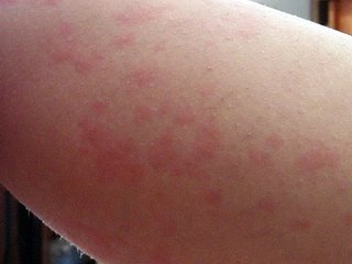 长荨麻疹要怎么治