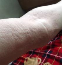 荨麻疹传染人不？