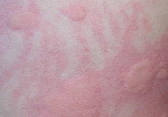 得了荨麻疹该怎么办