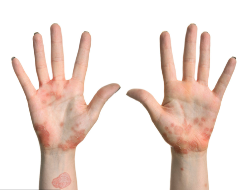 湿疹患者生活中如何食疗有助于病情治愈呢?