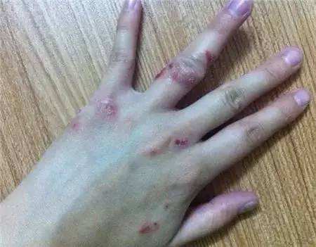 湿疹不同症状时期都有哪些表现以及如何治疗呢?