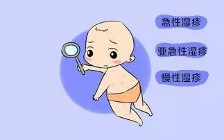 婴儿得了湿疹都有哪些民间土方法可以缓解损害呢?